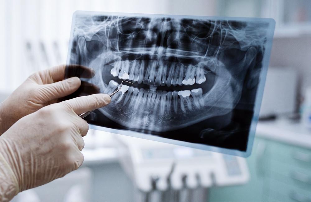 Dental Prosthetics After Tooth Loss What Are Your Best Options Blog 10