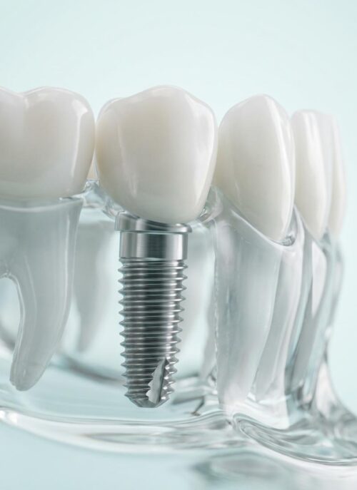 Smile prosthetics Service 04 1 500x687